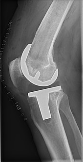 Рентгенова снимка след операция на колянна става. 