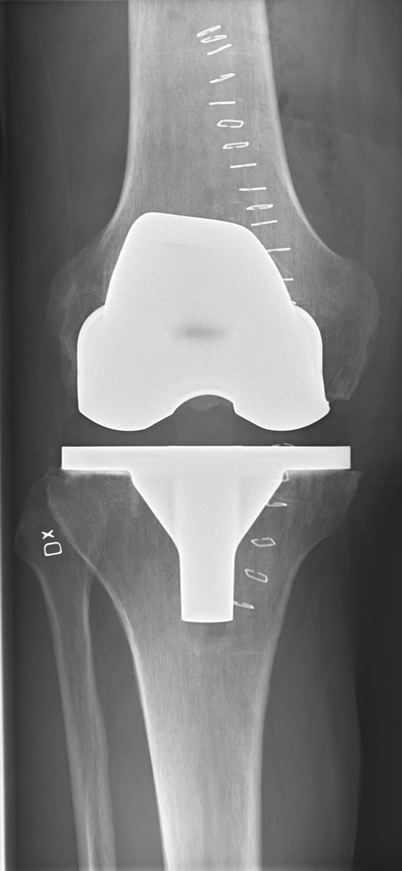 След смяна на колянна става - рентгенова снимка 1