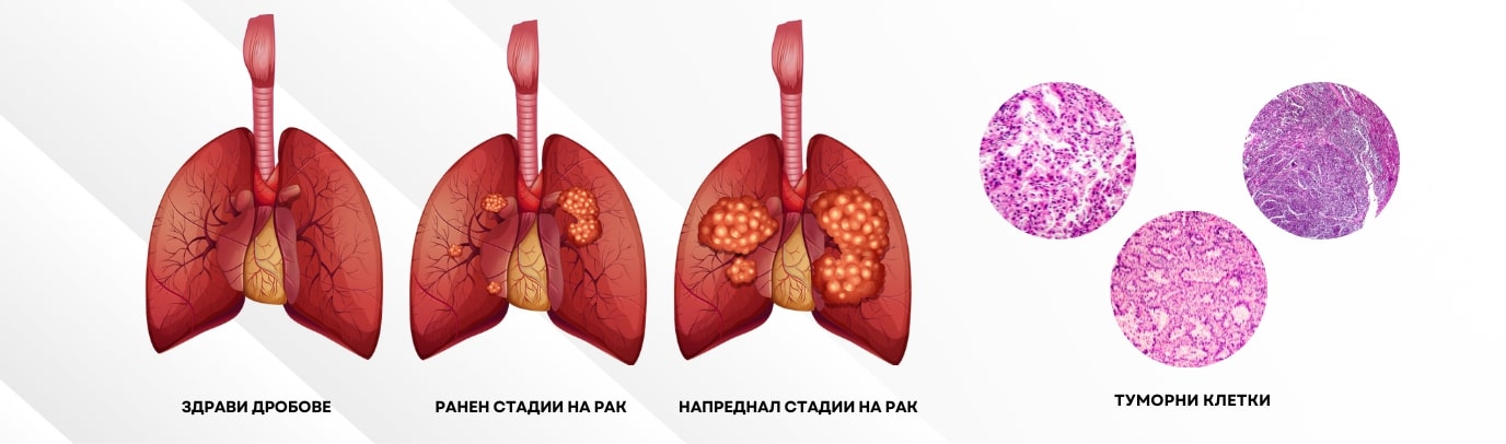 Рак на бял дроб | СЪСТОЯНИЕ - Adapt BG